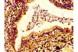 IHC image of ABIN7151695 diluted at 1:100 and staining in paraffin-embedded human lung cancer performed on a Leica BondTM system. (ERGIC2 Antikörper  (AA 55-310))