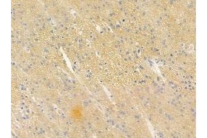 ABIN6258882 and ABIN6275716 at 1/100 staining human glioblastoma by IHC-P.