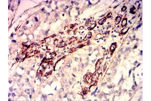 Immunohistochemical analysis of paraffin-embedded bladder cancer tissues using CALD1 mouse mAb with DAB staining. (Caldesmon Antikörper  (AA 26-207))