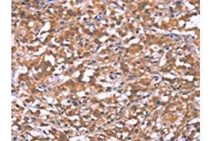 The image on the left is immunohistochemistry of paraffin-embedded Human thyroid cancer tissue using ABIN7190999(HRASLS2 Antibody) at dilution 1/20, on the right is treated with synthetic peptide.