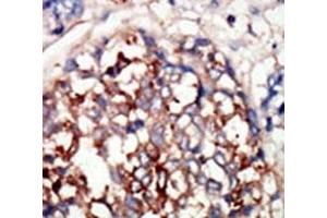 IHC analysis of FFPE human hepatocarcinoma tissue stained with the DYRKB antibody (DYRK1B Antikörper  (AA 561-589))