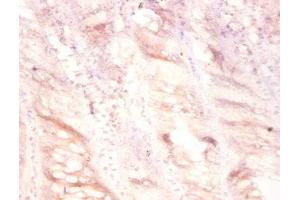 Immunohistochemistry of paraffin-embedded human colon cancer using ABIN7175129 at dilution of 1:100 (PLAU Antikörper  (AA 21-173))
