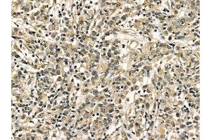 IRF3 Mouse Monoclonal Antibody at 1/100 staining human gastric cancer by IHC-P.