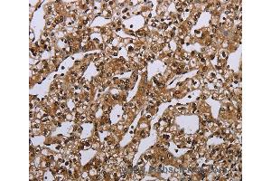 Immunohistochemistry of Human esophagus cancer using MEIS1 Polyclonal Antibody at dilution of 1:40