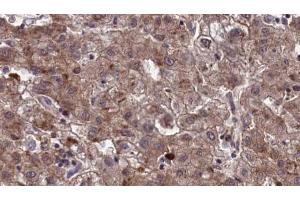 ABIN6273965 at 1/100 staining Human liver cancer tissue by IHC-P.