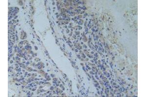 IHC-P analysis of Human Lung Cancer Tissue, with DAB staining. (TNFRSF1A Antikörper  (AA 248-428))