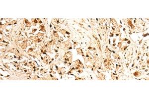 Immunohistochemistry of paraffin-embedded Human prost ate cancer tissue using JPT2 Polyclonal Antibody at dilution of 1:65(x200) (JPT2 Antikörper)