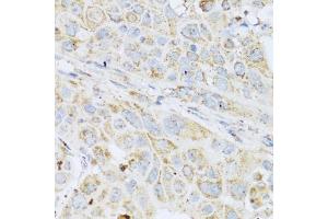 Immunohistochemistry of paraffin-embedded human esophageal cancer using LYZ antibody (ABIN5975352) at dilution of 1/100 (40x lens). (LYZ Antikörper)