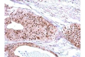 IHC-P Image Immunohistochemical analysis of paraffin-embedded human gastric cancer, using RFC3, antibody at 1:500 dilution. (RFC3 Antikörper)
