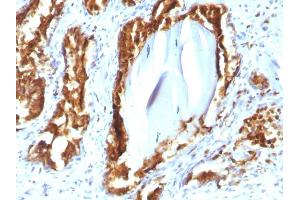 Formalin-fixed, paraffin-embedded human Prostate Carcinoma stained with PSAP Mouse Recombinant Monoclonal Antibody (rACPP/1338). (Rekombinanter ACPP Antikörper)