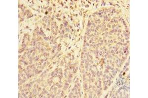 Immunohistochemistry of paraffin-embedded human ovarian cancer using ABIN7168416 at dilution of 1:100 (PDE6A Antikörper  (AA 656-860))