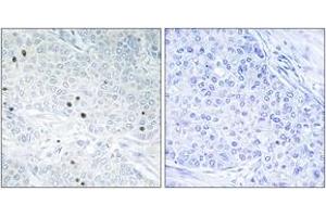 Immunohistochemistry analysis of paraffin-embedded human breast carcinoma tissue, using TP53INP2 Antibody. (TP53INP2 Antikörper  (AA 1-50))