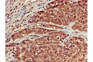 Immunohistochemistry of paraffin-embedded human ovarian cancer using ABIN7168699 at dilution of 1:100 (SCTR Antikörper  (AA 51-135))