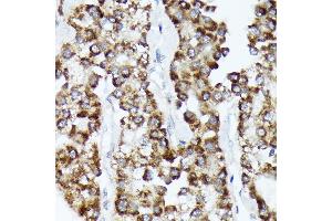 Immunohistochemistry of paraffin-embedded human liver cancer using CDC Rabbit mAb (ABIN7266261) at dilution of 1:100 (40x lens). (CDCA3 Antikörper)