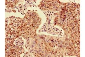 Immunohistochemistry of paraffin-embedded human cervical cancer using ABIN7143262 at dilution of 1:100 (Acyp2 Antikörper  (AA 28-87))