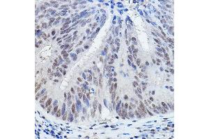 Immunohistochemistry of paraffin-embedded human colon carcinoma using DGCR8 Rabbit pAb (ABIN7266761) at dilution of 1:200 (40x lens). (DGCR8 Antikörper)
