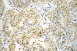 Immunohistochemistry was performed on paraffin-embedded human endometrial carcinoma using annexin A1 antibody (ABIN7797612), 1:200). (Annexin a1 Antikörper)
