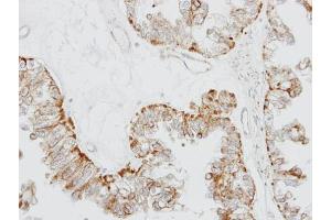 IHC-P Image Immunohistochemical analysis of paraffin-embedded OVCA xenograft, using GPR164, antibody at 1:100 dilution. (OR51E1 Antikörper)