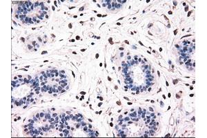 Immunohistochemical staining of paraffin-embedded breast tissue using anti-BRAF mouse monoclonal antibody. (BRAF Antikörper)