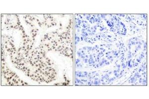 Immunohistochemical analysis of paraffin-embedded human breast carcinoma tissue using Elk-1 (phospho-Thr417) antibody. (ELK1 Antikörper  (pThr417))