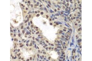 Immunohistochemistry of paraffin-embedded Human oophoroma using CENPC Polyclonal Antibody at dilution of 1:200 (40x lens). (Centromere Protein C Pseudogene 1 (CENPCP1) Antikörper)