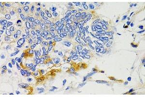 Immunohistochemistry of paraffin-embedded Human gastric cancer using PTPN11 Polyclonal Antibody at dilution of 1:100 (40x lens). (PTPN11 Antikörper)