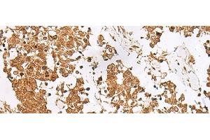 Immunohistochemistry of paraffin-embedded Human lung cancer tissue using SCRN2 Polyclonal Antibody at dilution of 1:60(x200) (SCRN2 Antikörper)