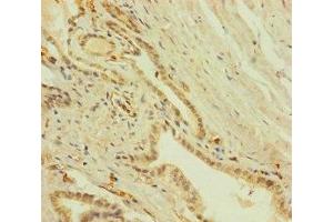 Immunohistochemistry of paraffin-embedded human prostate cancer using ABIN7151756 at dilution of 1:100 (ZNF71 Antikörper  (AA 101-300))