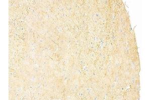 ABIN6261669 and ABIN6273242 at 1/100 staining human glioblastoma by IHC-P. (FAM65B Antikörper  (Internal Region))