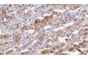 ABIN6272580 at 1/100 staining Human liver cancer tissue by IHC-P. (GRIK5 Antikörper  (Internal Region))