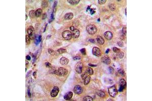 Immunohistochemical analysis of IKK gamma staining in human breast cancer formalin fixed paraffin embedded tissue section.