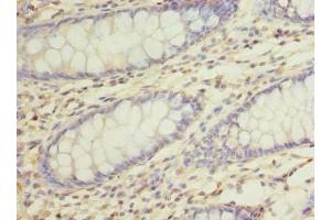 Immunohistochemistry of paraffin-embedded human colon cancer using ABIN7168469 at dilution of 1:100 (RUSC1 Antikörper  (AA 231-433))