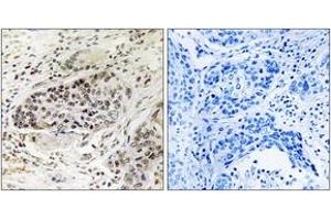 Immunohistochemistry analysis of paraffin-embedded human lung carcinoma tissue, using APBA2 Antibody. (APBA2 Antikörper  (AA 371-420))
