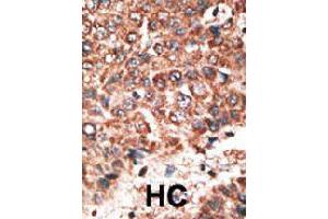 Formalin-fixed and paraffin-embedded human hepatocellular carcinoma tissue reacted with MMP20 polyclonal antibody  , which was peroxidase-conjugated to the secondary antibody, followed by DAB staining. (MMP20 Antikörper  (Internal Region))
