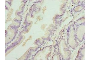 Immunohistochemistry of paraffin-embedded human prostate cancer using ABIN7149547 at dilution of 1:100 (DEDD Antikörper  (AA 1-318))