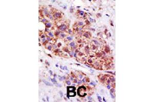 Formalin-fixed and paraffin-embedded human cancer tissue reacted with UBE2B polyclonal antibody  , which was peroxidase-conjugated to the secondary antibody, followed by DAB staining. (UBE2B Antikörper  (C-Term))