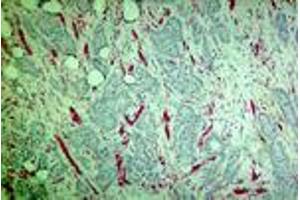 Carcinoma of the breast (MAb CE6, PECAM-1) (CD31 Antikörper)