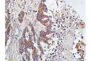Formalin-fixed and paraffin embedded human colon carcinoma labeled with Rabbit Anti-TIMP-1(NT) Polyclonal Antibody, Unconjugated (ABIN668331) at 1:200 followed by conjugation to the secondary antibody and DAB staining. (TIMP1 Antikörper  (AA 103-207))