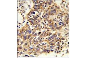 Immunohistochemistry: AP17923PU-N CAT Antibody staining of Formalin-Fixed, Paraffin-Embedded Human Lung carcinoma.