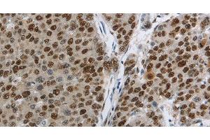 Immunohistochemistry of paraffin-embedded Human liver cancer using MCM3 Polyclonal Antibody at dilution of 1:30 (MCM3 Antikörper)