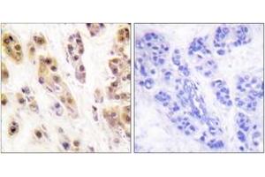 Immunohistochemistry analysis of paraffin-embedded human breast carcinoma, using SSB (Phospho-Ser366) Antibody. (SSB Antikörper  (pSer366))