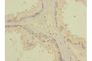 Immunohistochemistry of paraffin-embedded human prostate cancer using ABIN7171903 at dilution of 1:100 (TTC12 Antikörper  (AA 1-260))