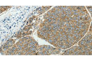 Immunohistochemistry of paraffin-embedded Human liver cancer tissue using SLC16A1 Polyclonal Antibody at dilution 1:50 (SLC16A1 Antikörper)