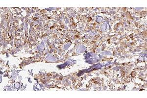 ABIN6277005 at 1/100 staining Human Melanoma tissue by IHC-P. (APCS Antikörper  (Internal Region))