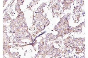 ABIN6273033 at 1/100 staining Human breast cancer tissue by IHC-P.