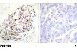 Immunohistochemical analysis of paraffin-embedded human breast carcinoma tissue using KIF20A polyclonal antibody . (KIF20A Antikörper)