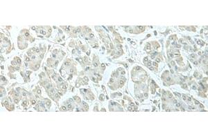 Immunohistochemistry of paraffin-embedded Human gastric cancer tissue using C8orf4 Polyclonal Antibody at dilution of 1:55(x200)