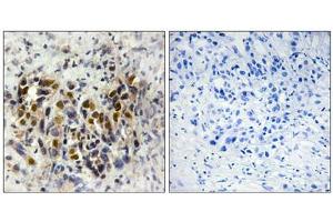 Immunohistochemistry analysis of paraffin-embedded human breast carcinoma tissue, using IRX3 antibody. (IRX3 Antikörper  (Internal Region))