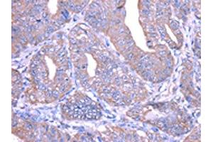 The image on the left is immunohistochemistry of paraffin-embedded Human esophagus cancer tissue using ABIN7128033(THAP6 Antibody) at dilution 1/25, on the right is treated with fusion protein. (THAP6 Antikörper)