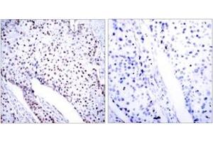 Immunohistochemistry analysis of paraffin-embedded human breast carcinoma tissue, using STAT3 (Ab-705) Antibody. (STAT3 Antikörper  (AA 672-721))